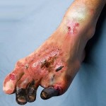Panama 2010 Health Effects vascular system - gangrene, gross, diseased foot